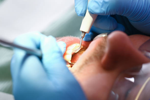 Best Emergency Treatment for Dental Infections or Abscesses in West Yellowstone, MT